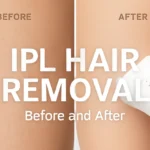IPL Hair Removal